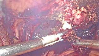 Endometriosis Surgery- Laparoscopic Management of Vault Endometriosis