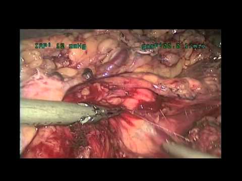 Laparoscopic Enculeation Of Insulinoma