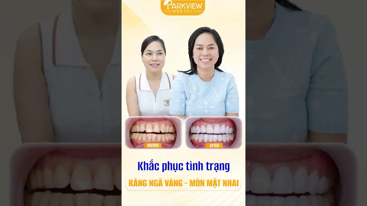 Giải Pháp Khắc Phục Răng Ố Vàng Mòn Mặt Nhai An Toàn, Bền Lâu