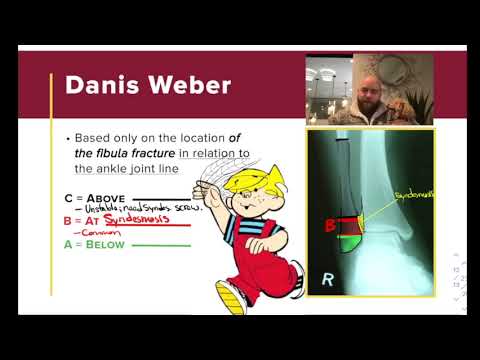 Danis-Weber Classification of Fibula Fractures