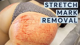 Stretch Mark Removal & Extreme Vampire Butt Facial