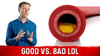 You Have Good and Bad LDL (low-density lipoprotein)