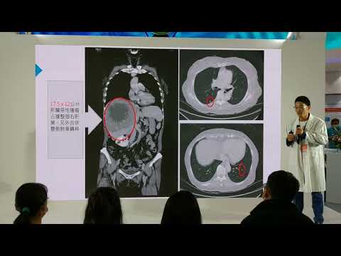 WT1癌症疫苗及GDT，不須開刀的細胞免疫癌症治療-細胞治療中心 張伸吉主任-2023醫療科技展-醫師聊健康 youtube影片圖片