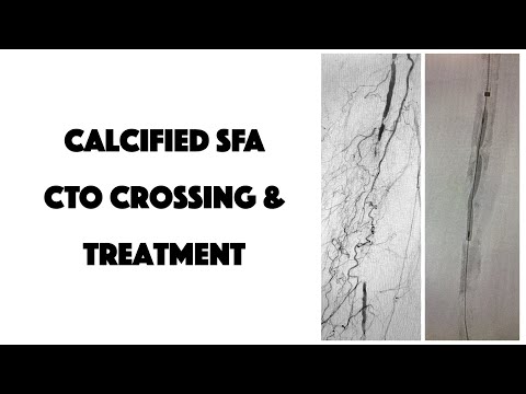 Heavily Calcified SFA CTO Crossing & Treatment