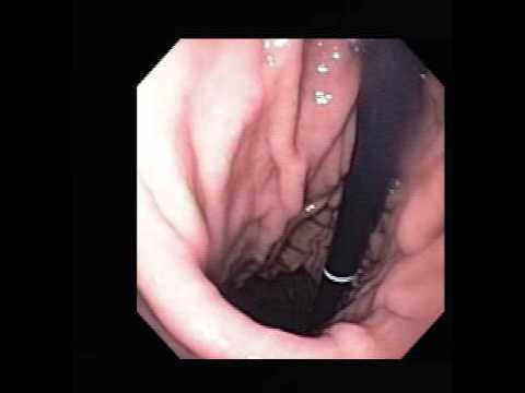 Endoscopy Video