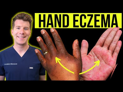 Doctor explains how to recognise and treat HAND ECZEMA (dermatitis) | Causes, symptoms & prevention