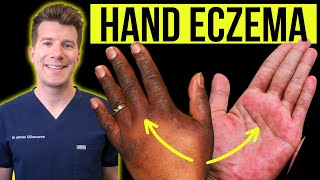 Doctor explains how to recognise and treat HAND ECZEMA (dermatitis) | Causes, symptoms & prevention