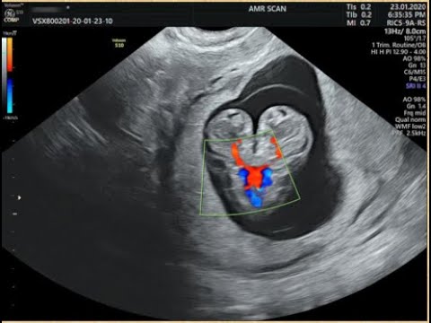 case of the week 3 fetal ultrasound conjoined twin (thoracopagus)
