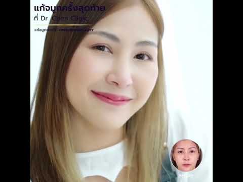 แก้จมูกครั้งสุดท้าย กับ Dr.Chen 