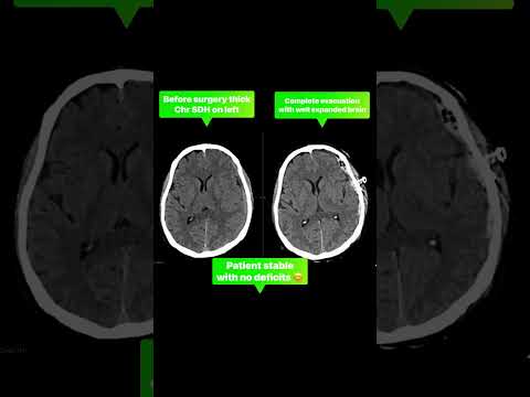 Chronic Subdural Hematoma Recovery 
