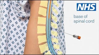 Download lagu Having a lumbar puncture mp3