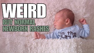 Newborn Baby Rashes on Face and Skin