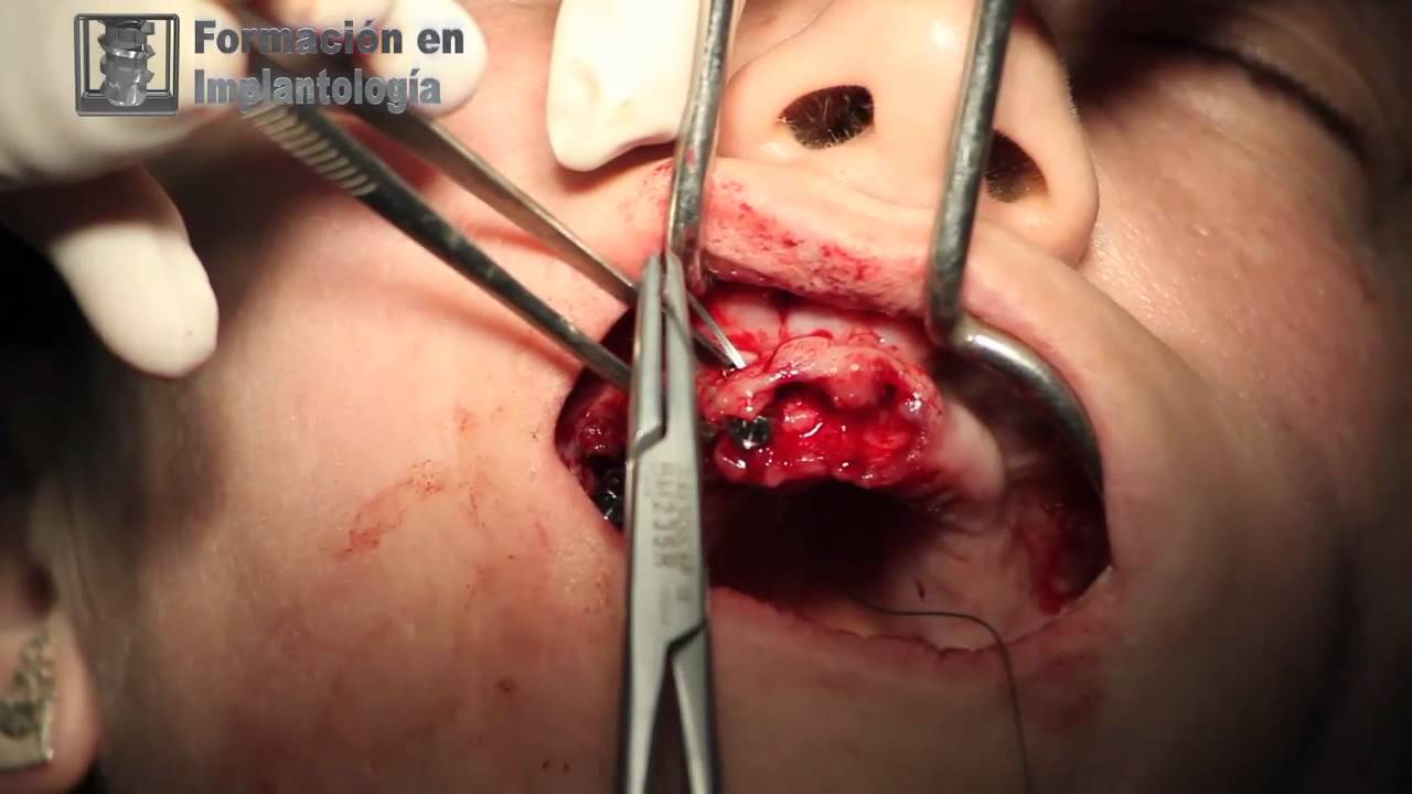 Sinus lifts, plasma and PRP graft with GMI implants