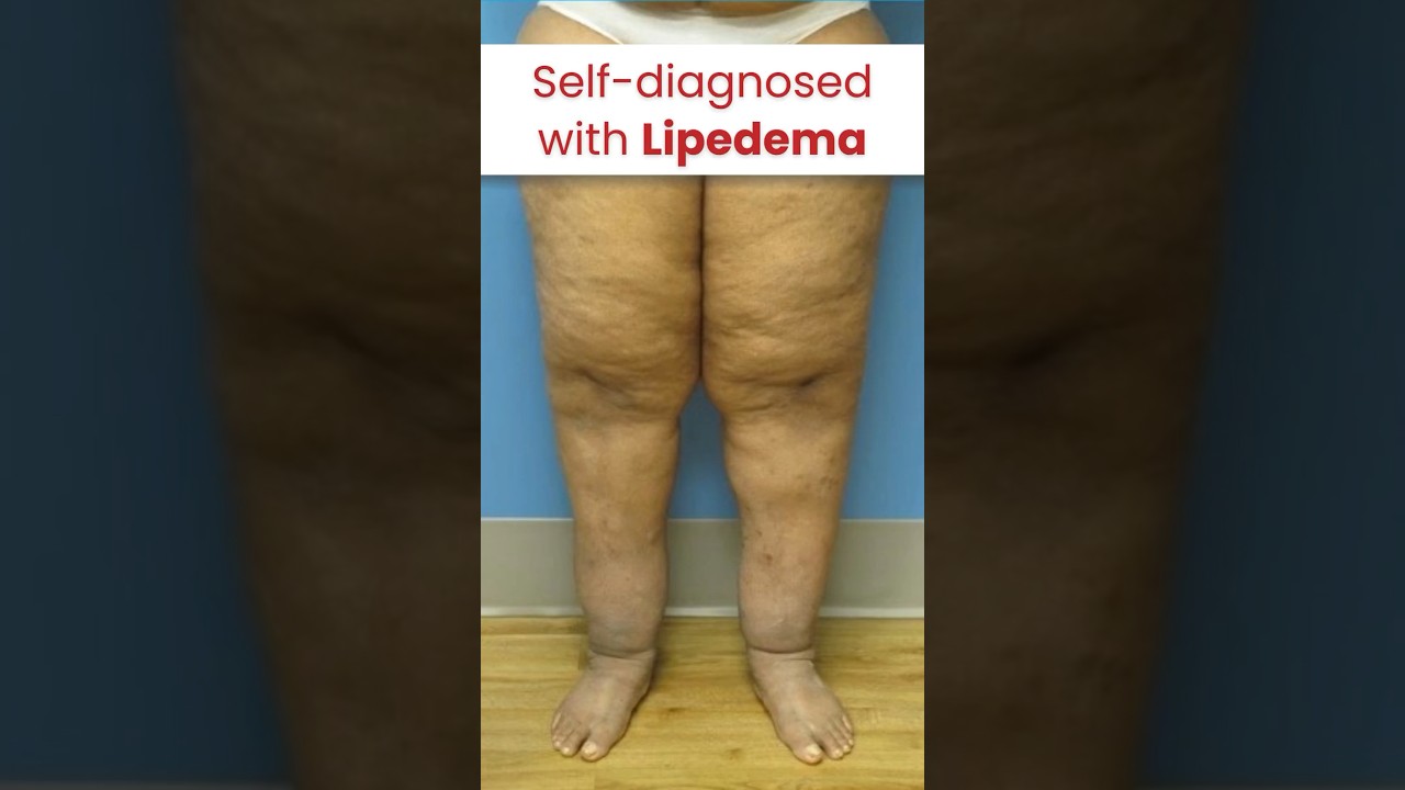 She self-diagnosed with Lipedema. Were you too? #lipedema #shorts_feed