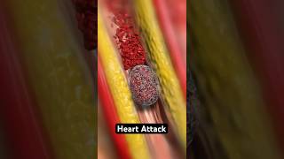 Heart Attack (3D Animation)