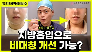 볼살만 지방흡입해도 턱선이 보일까? l  지방 비대칭 vs 골격 비대칭