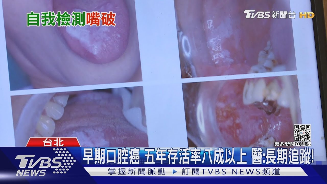 輕忽「嘴破」這幾種症狀 醫:罹「口腔癌」機率增速就醫!