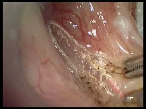 Laser assisted cordectomy with KLS Martin MCO 25plus and micromanipulator Micro Point