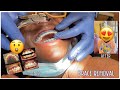 Brace Removal 23 Months Treatment