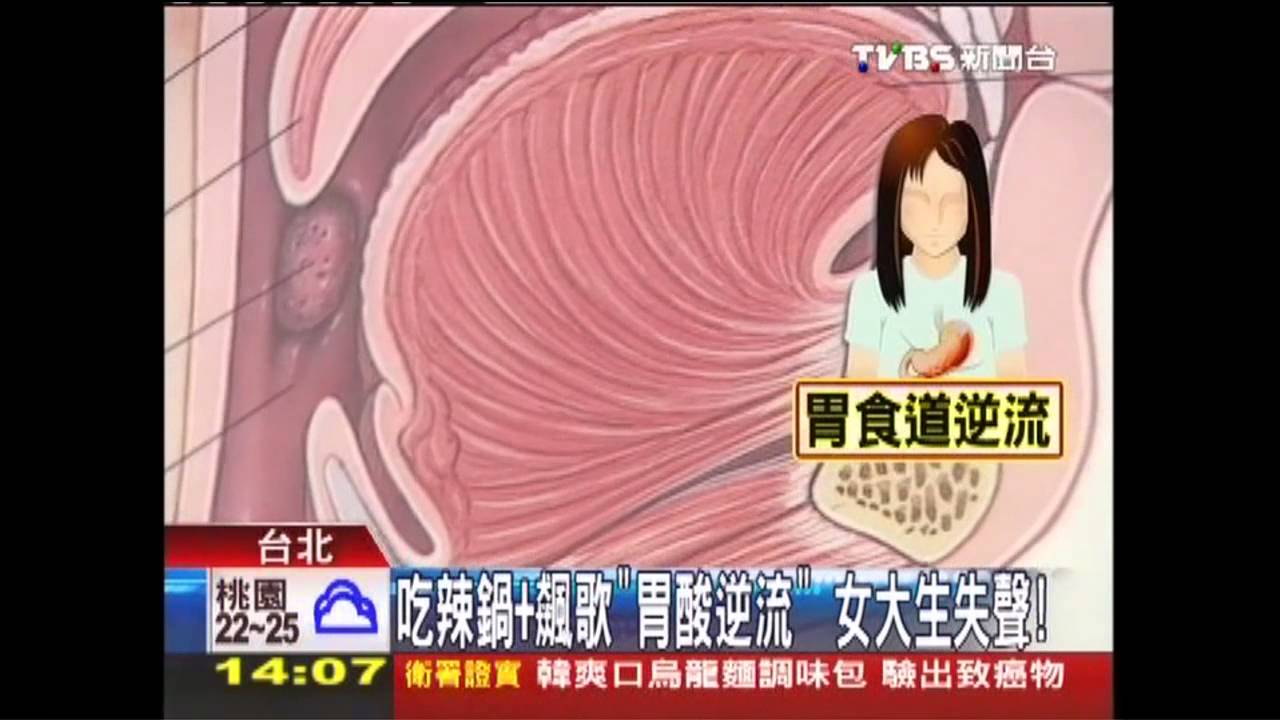 吃辣鍋+飆歌!「胃酸逆流」 女大生失聲