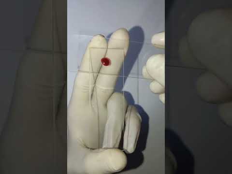 peripheral blood smear🩸