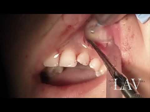 Trattamento dei depositi cervicali Caviglia prezzo blocco