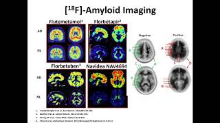 The Latest on Dementia with Dr  Paul Schulz