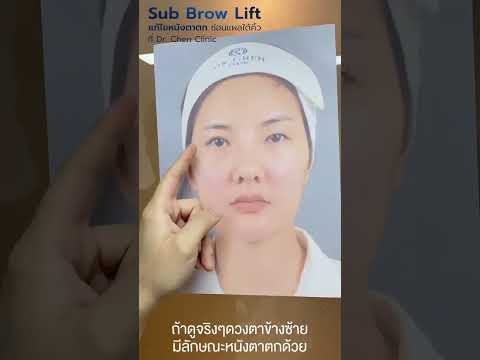 EP.1 ชั้นตาไม่เท่ากัน ระดับคิ้วไม่เท่ากัน แก้อย่างไร? 🤓