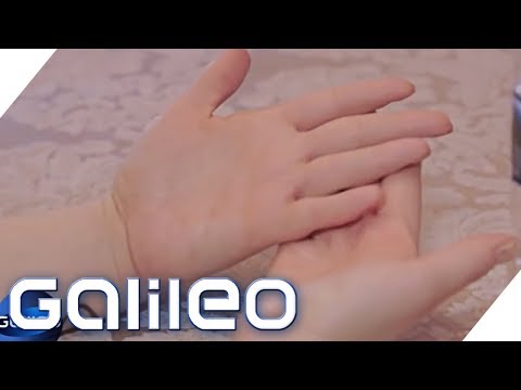 This woman has no fingerprints | Galileo | ProSieben