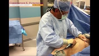 Dr. Patronella Gives This Woman a Better Waistline and Proportions