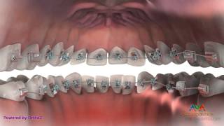 preview picture of video 'Lingual Braces (Hidden Braces) - Orthodontic Treatment'