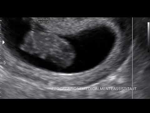Ecografia Gravidanza Feto di 11 cm