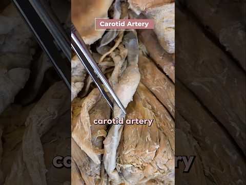 Understanding an Ischemic Stroke