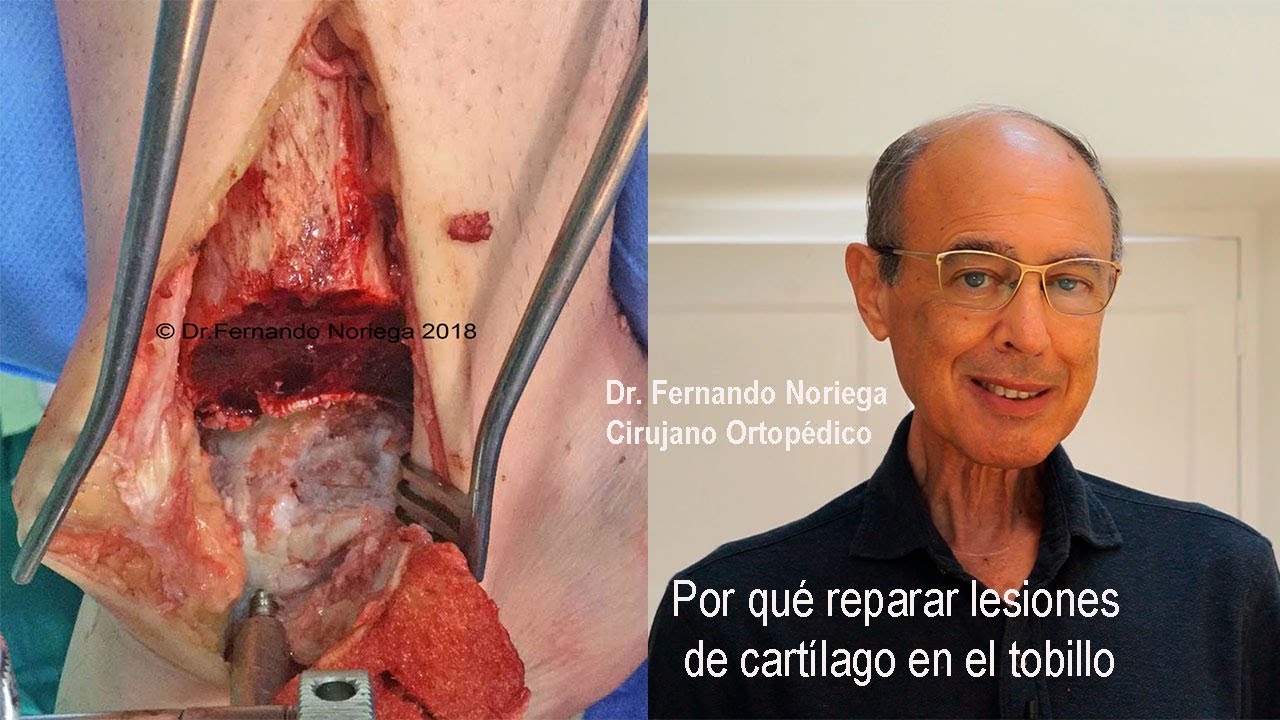 Watch LESIONES de CARTILAGO del TOBILLO:Por quÉ REPARARLAS Now LESIONES de CARTILAGO del TOBILLO:Por quÉ REPARARLAS