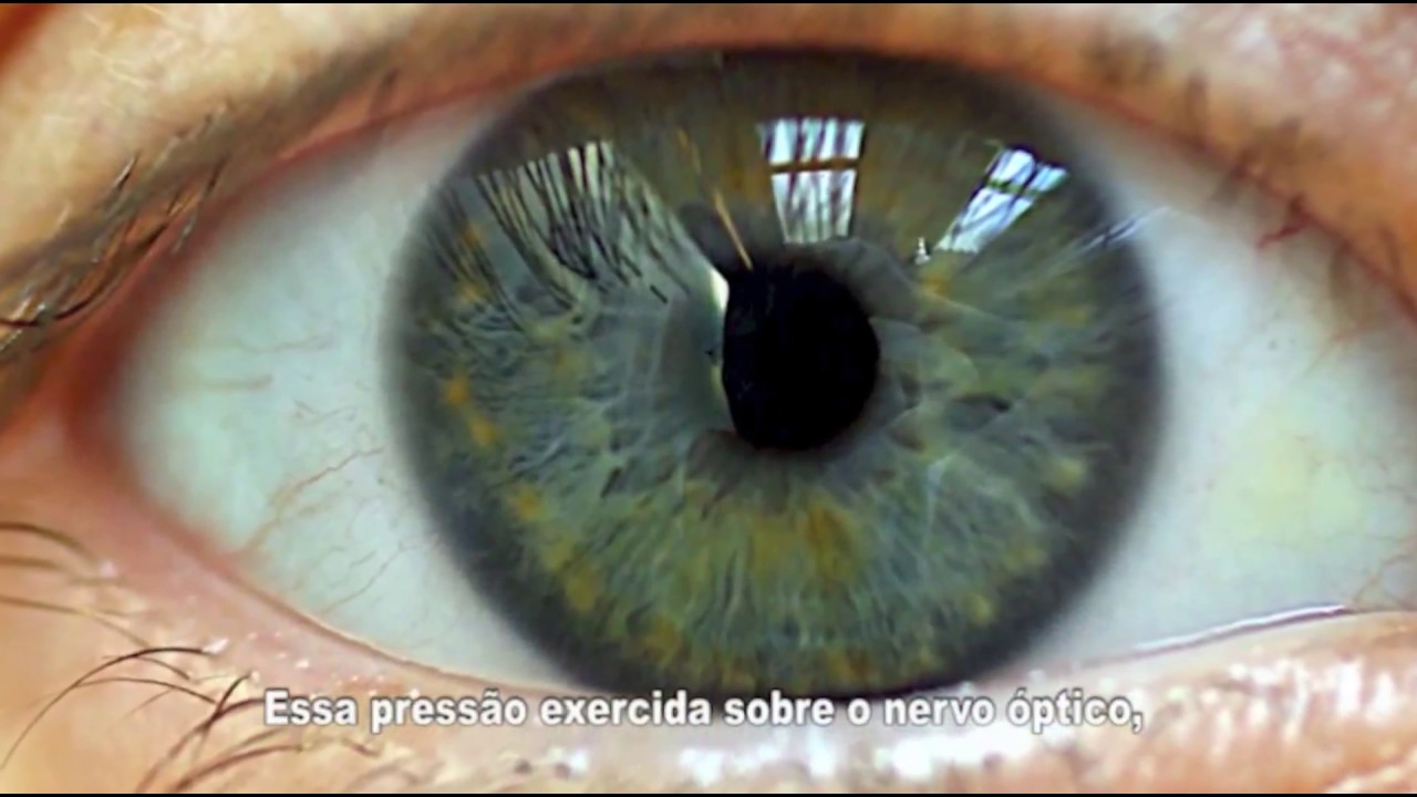 Glaucoma tem cura? www.iorj.med.br