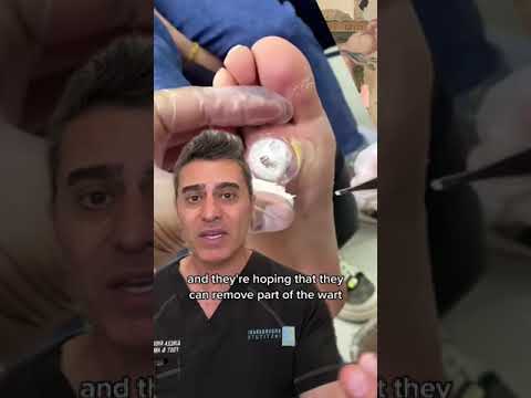 " Huge Wart " on Foot...