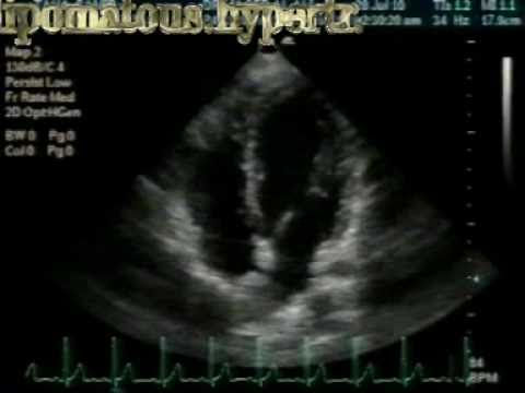 Lipomatous Hypertrophy Of The Interatrial Septum (1)