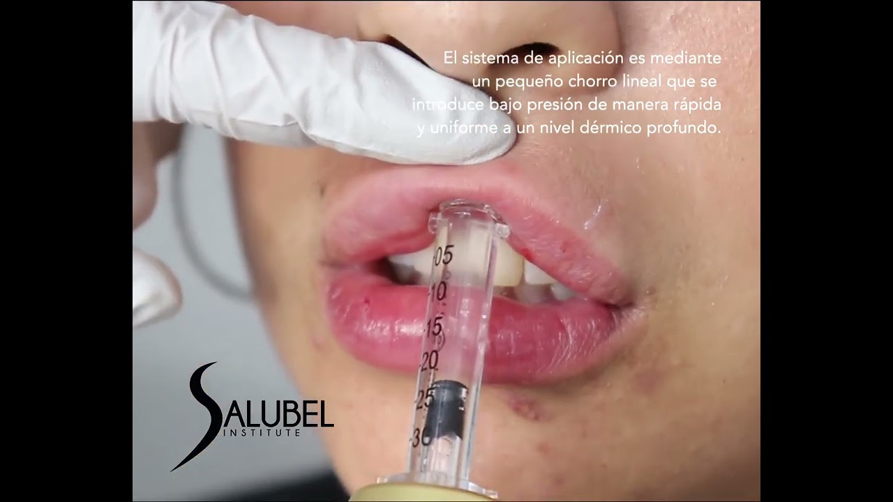 ✨ Relleno de Labios con Hyaluron Pen ✨