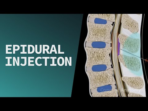 Epidural Injection