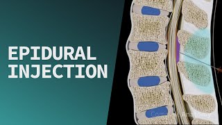 Download lagu Epidural Injection mp3