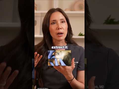 How to Treat Milia: Part I