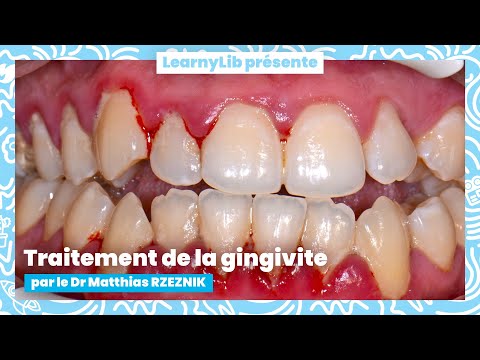 🦷 Periodontics: treatment of gingivitis with Dr. Matthias RZEZNIK