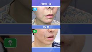 입술 리프트 성형 시술