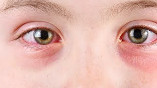 Mayo Clinic Minute - What is pink eye?