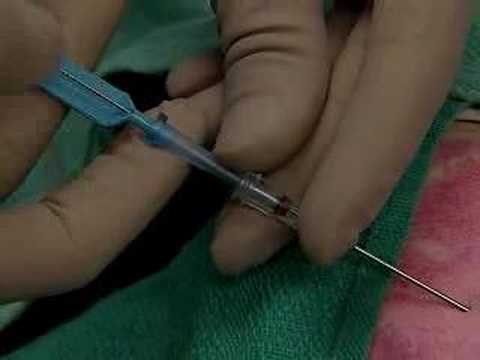 Central line placement