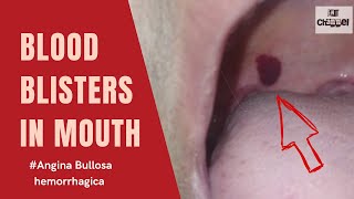 Angina bullosa Haemorrhagica I Blood filled blisters at roof of mouth I Cause and treatment