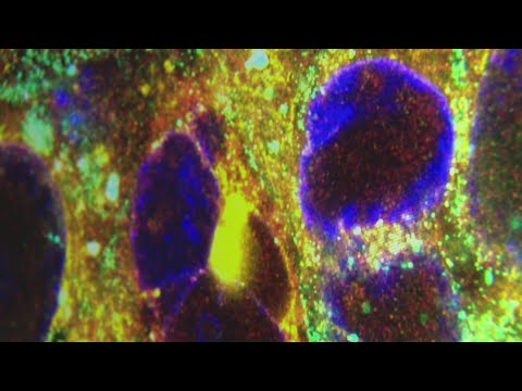 Herpes’ connection to cancer: What doctors are learning from the virus