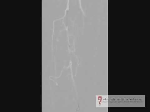 Subintimal Angioplasty