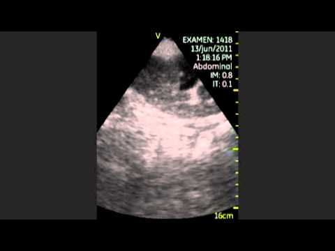 Transplanted Kidney Hydronephrosis