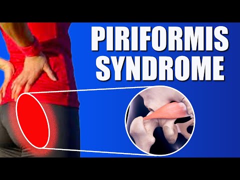 Piriformis Syndrome l (Pain Relief Exercises l Causes l Diagnosis l Symptoms)